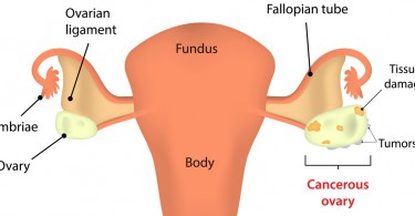 Ovarian Cancer