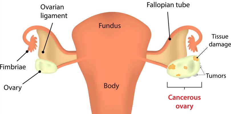 Ovarian Cancer